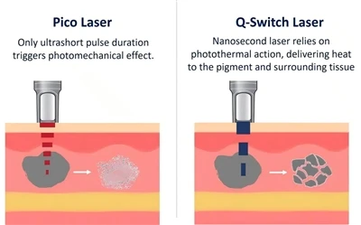 „Pico Laser Vs Q-Switch Laser“ saugos priemonės