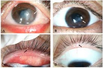 IPL laser risk to the eyes IPL laser risk to the eyes